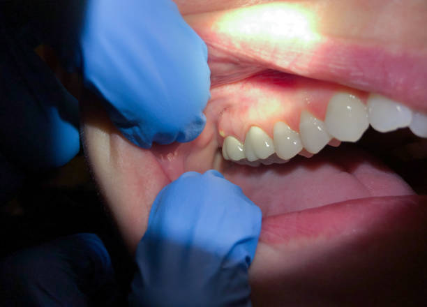 Best Emergency Root Canal Treatment in Monmouth Junction, NJ